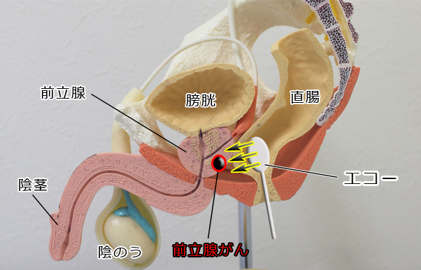 当院の前立腺生検の方法